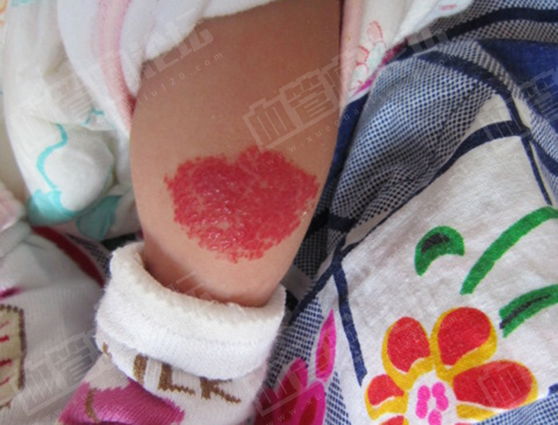 宝宝腿上花纹状的血管图片