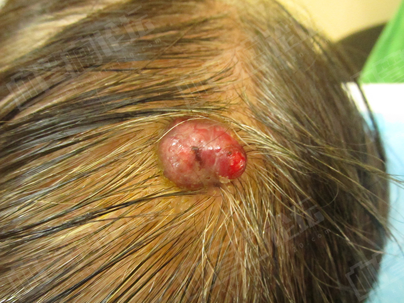 头皮血管肉瘤图片
