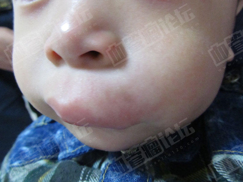 小孩唇部混合型血管瘤治疗日记